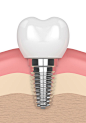 牙齿植入物在牙龈中的3d呈现器图片素材-图片ID：312489541
