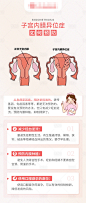 子宫内膜异位症不孕科普长图海报-源文件