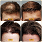 Amazon.com : Minoxidil 5% Hair Growth Serum Oil Biotin Hair Regrowth Treatment for Scalp Hair Loss Hair Thinning, Hair Growth Serum for Men Women 1 fl.oz : Beauty & Personal Care