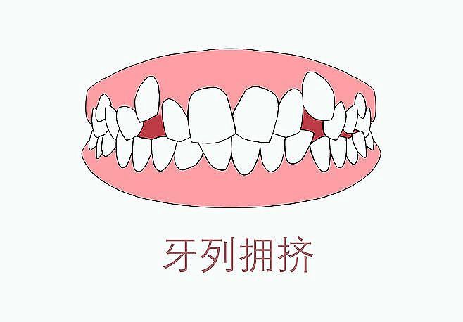 1、牙列拥挤