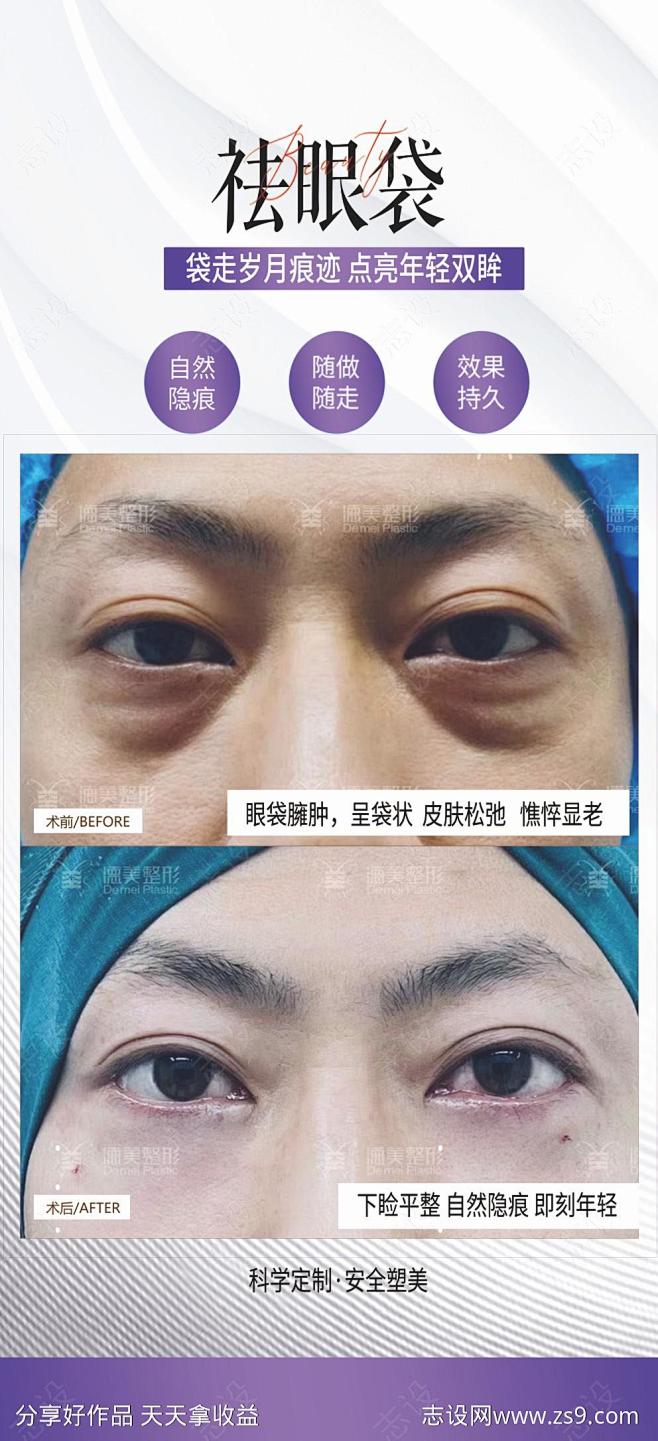 祛眼袋案例海报-源文件-志设网-zs9....