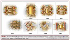 脊柱畸形的最新进展 Recent and Emerging Advances in Spinal Deformity 【论文医学插画欣赏】国内外文献全文可以为您免费传递！QQ 18147895 活动详情见 O网页链接 ★★★ 喜欢 医学插画 医学美图 医学插图 医学美术 医学可视化 医学插画师 医学动画 请关注我。★★★请前往高能区域  ​​​​...展开全文c