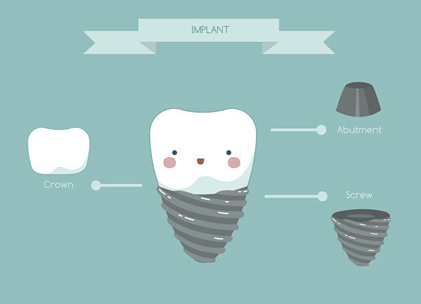 牙种植体结构，牙齿和牙齿概念牙科矢量图素...