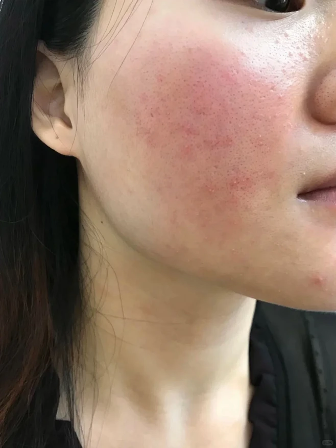 都给我狠狠敷！！！（过敏泛红）-花瓣网