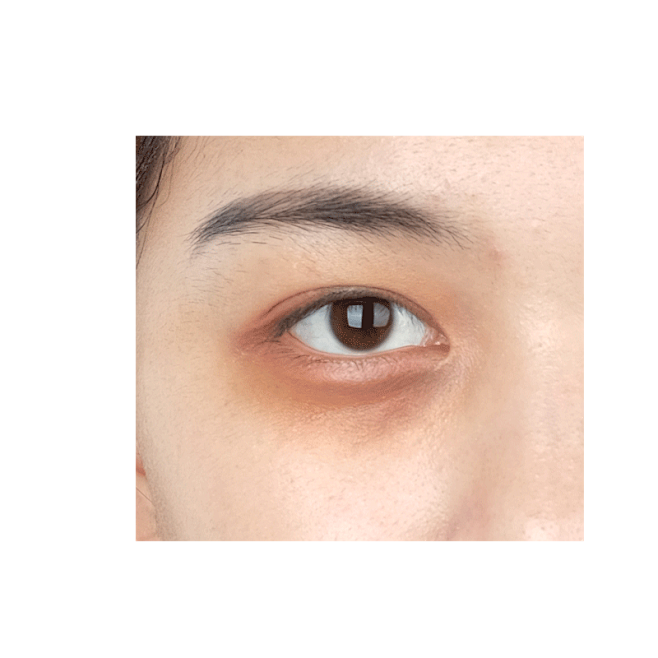 眼袋5