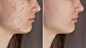 Cropped shot of young womans face before and after acne treatment on face pimples rash on cheeks