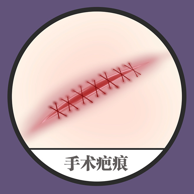 疤痕 疤痕消除 疤痕体质 疤痕增生如何消...