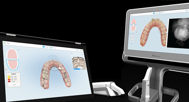 iTero Intraoral Scan...