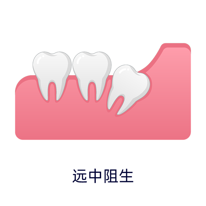 智齿形态及种类---远中阻生智齿