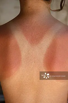 孩子的晒伤皮肤图片素材