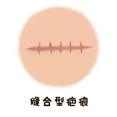 医疗美容整形插画 卡通手绘漫画  疤痕不同类型 修复治疗疤痕