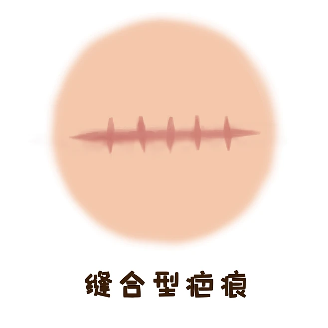 医疗美容整形插画 卡通手绘漫画 疤痕不同类型 修复治疗疤痕-花瓣网