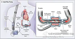 一个完全的磁悬浮的循环泵，用于进展的心脏衰竭 A Fully Magnetically Levitated Circulatory Pump for Advanced Heart Failure 【论文医学插画欣赏】国内外文献全文可以为您免费传递！QQ 18147895 活动详情见 O网页链接 ★★★ 喜欢 医学插画 医学美图 医学插图 医学美术 医学可视化 医学插 ​​​​...展开全文c