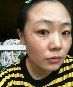 南京祛痘新趋势：寻找那抹肌肤洁净的光