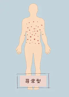寻常型
银屑病局部全身 皮肤 皮肤疾病 牛皮癣 红斑 皮肤病变 皮肤疾病 医疗美容整形
医疗美容整形插画 卡通手绘漫画案例图范图 可爱女孩美女 脸部面部全身症状系列