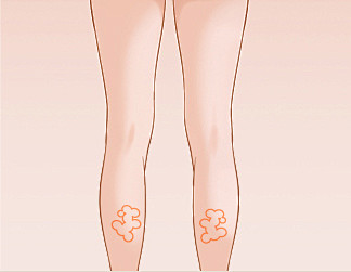 小腿吸脂