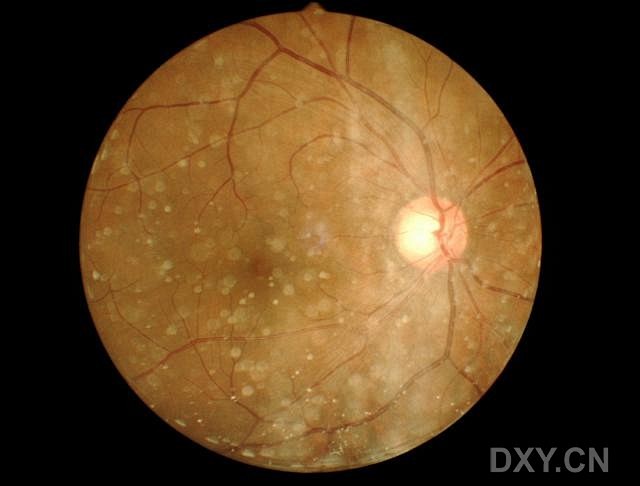 玻璃体星样变性