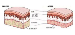 咖啡杯与筷子采集到皮肤结构