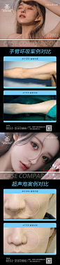 医美案例对比手臂环吸超声炮海报-素材库-sucai1.cn