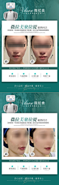医美案例对比图海报 