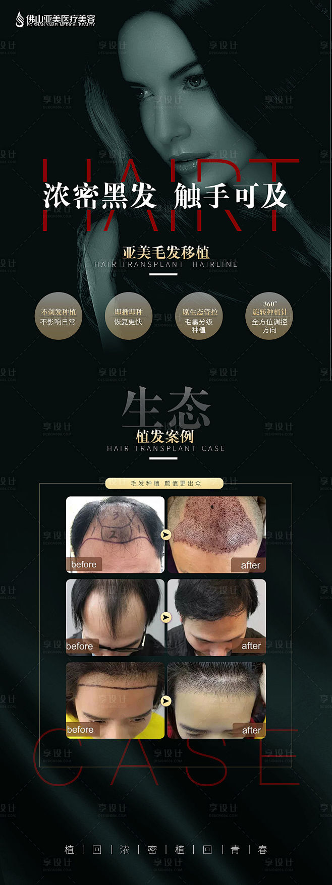 毛发种植X展架-源文件
