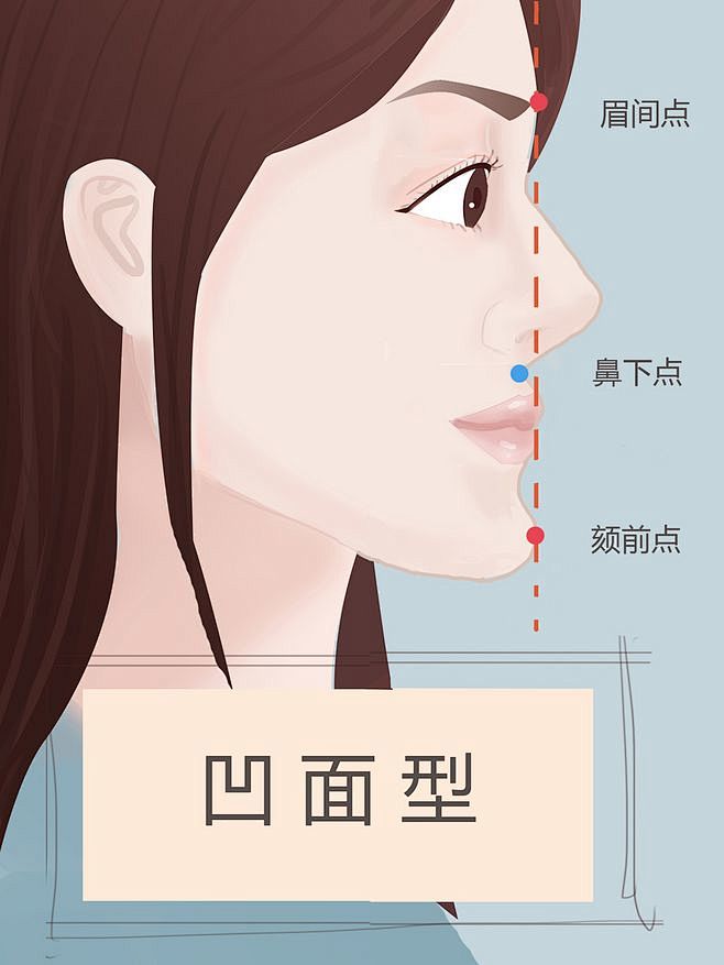 面型面部脸部综合凹面型凸面型直面型改善面型塌眼窝骨性错颌矫正