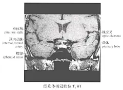 鞍区MR解剖图侧脑室