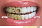 脑洞大开的创意广告牙齿保护广告：比较重口味的一则平面广告。广告创意算不上有多新奇，但画面表现力非常棒。护牙前后的鲜明对比，冲击力还是很强的。