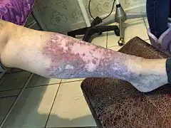 淤积性皮炎的搜索结果_百度图片搜索