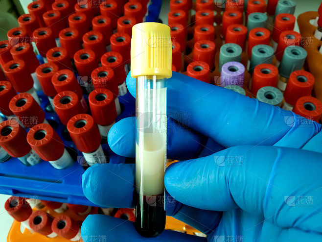 由医学技术人员持有的血脂血样取样管。在医学实验室评估病人的甘油三酯、血脂、胆固醇和心脏指标。