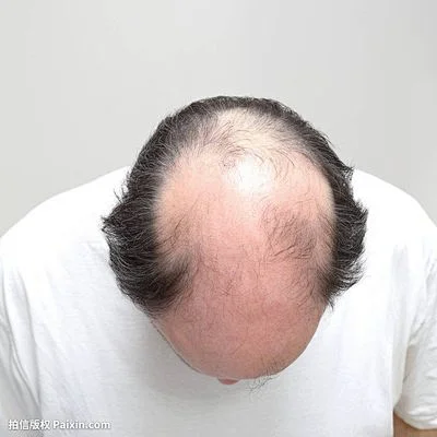 秃顶的 搜索结果_360图片