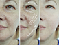 face wrinkles before and after