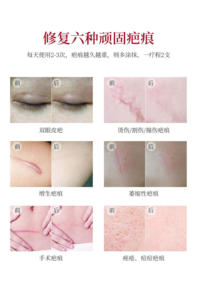 威格菲（WGFei）去疤膏 医用祛疤膏剖...