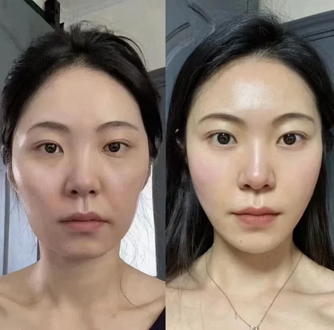 恰到好处的填充，饱满减龄又幼态