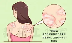 不是所有红斑都是癣，皮肤长了癣该这样做！ - 知乎