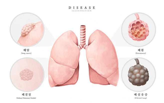 医院肺病肺结核肺纤维化肺癌呼吸系统支气管...