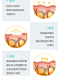 Dermatix倍舒痕儿童进口专用祛疤硅凝胶手术脸部修复疤痕烫伤7g-tmall.hk天猫国际