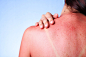 Lathering On the Aloe Vera? Six Ways to Treat Sunburn : Scott & White dermatologist Katherine Fiala, MD works with people everyday who suffer from skin problems and offers some tips to deal with sunburn.