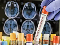 科学家拿着血样研究治疗阿尔茨海默病的方法，概念图像