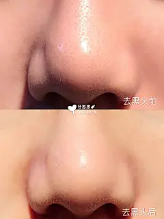 良心安利|用过最好用的去黑头鼻贴没有之一⚠️ : 如何有效去黑头 去黑头用什么面膜  作为一个混油皮，去黑头真的对我很重要～ 今天想安利的是这款cnp去黑头鼻贴#CNP，闺蜜安利我的，大约已经用了一年多两年了吧 用了这款鼻贴之后就再也没有用过其他