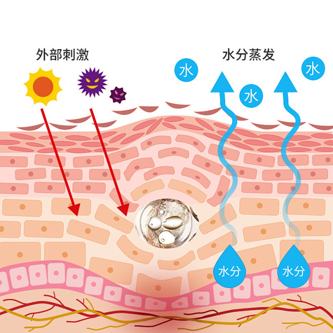 注射玻尿酸引起皮肤感染发炎