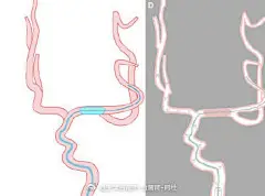 介入科的博士要画的超简单的示意图 立马完成 #动画# #灵感的诞生# ​#3D# #设计# #科学插画# #医学科普# #论文医学插画欣赏# #怎样成为医学插画师# #怎样成为医学动画师# #医学插画# #医学美图# #每日一画# ​ ​​​​