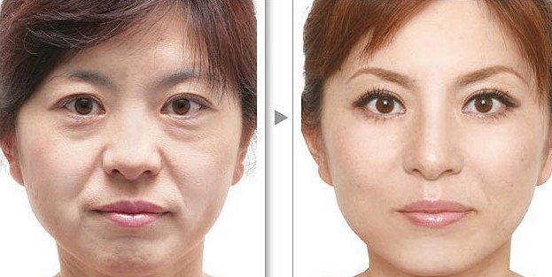 M唇微笑唇术前术后的 搜索结果_360图...