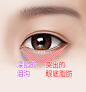 下眼睑整形