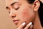 redness face - Google 搜索