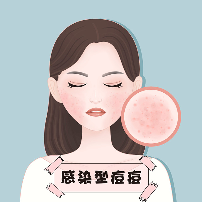 感染型痘痘 脸部面部痤疮痘痘青春痘医疗美...