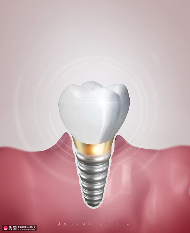 闪亮牙齿种植新生牙龈螺丝医美海报海报招贴...