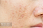 痤疮疤痕和毛孔。暗斑。皱纹和皮肤问题,Acne scars and pores. Dark spots. Wrinkles and skin problems - 图虫创意-全球领先正版素材库-Adobe Stock中国独家合作伙伴