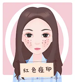 黑色痘印 凹洞性疤痕 红色痘印 增生性凸疤  疤痕  痘痘  痘印类型  脸部  面部  祛斑  皮肤病   去痘印  果酸换肤  缩小毛孔  改善闭口  清洁祛痘   面部暗沉  控油控痘  收缩毛孔  痘肌消炎  美颜活肌  淡化疤痕   痘印 痘痘 痘坑 面部 去粉刺 去痘痘 去痘印 红蓝光祛痘 粉刺清除术 消除暗疮 祛痘综合 祛痘美白提亮肤色 淡化色斑 收缩毛孔 细腻毛孔 果酸换肤
