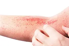 特应性皮炎(AD)，又称特应性湿疹，是手部皮肤的一种炎症(皮炎)图片下载